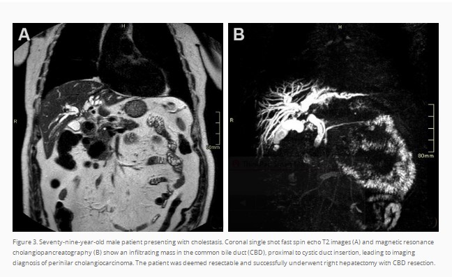 HepatomaRes's tweet photo. #livertwitter #GITwitter #MRI #CT A truly must-read on "Radiological imaging and non-surgical local treatments for cholangiocarcinoma". This is a master piece by Dr. Francesco De Cobelli's team. https://t.co/W8fVRK7W8t

@FDeCobelli @ShimaghavimiMD @LouisHSLau @vij_mukul https://t.co/hhTz0kfll0