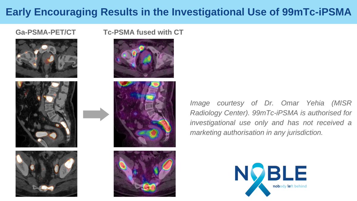 NobleRegistry's tweet photo. Discover the article by Dr. Omar Yehia, PI at the MISR Radiology Center in Egypt for the #NOBLERegistry regarding the encouraging early results in the investigational use of 99mTc-iPSMA for #prostatecancer screening
#SPECT #seeittreatit #cancercare
https://t.co/KaJnhhy7vH https://t.co/F85UzXiGgX