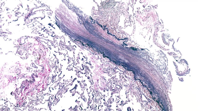 SansanoValero's tweet photo. Concentric subepithelial fibrosis w luminal narrowing and obliteration of small bronchioles. Normal distal parenchyma. Easily overlooked in HE (right) beatifully demonstrated on elastic stain (left) #pulmpath #transplantpath https://t.co/NiQ66B6GIZ