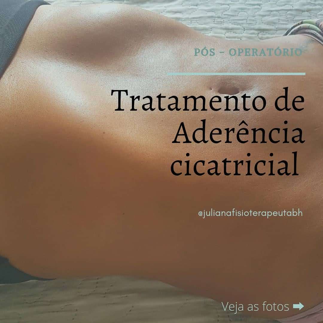 JulianaRFisio's tweet photo. Me siga nas redes sociais e saiba mais:
https://t.co/ejGHWkkaRP
#posoperatorio #fisioterapia #lipoaspiracao https://t.co/yu2fN26UAb