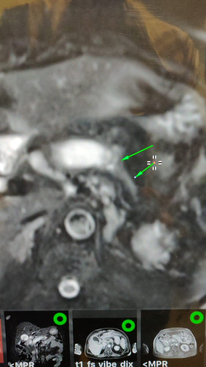 IRKsome (@liverserjun) on Twitter photo 68/F T2DM, midabdominal pain 6/10 requiring non-opiods x 3 months. No GB stones/jaundice/weight loss.
CA19-9 1682 & 864 2 weeks apart. MRI +MRCP 👇 <a href="/surgery_cancer/">GastroIntestinal Cancer Surgery</a> <a href="/surgery_hps/">Heidelberg Pancreatic Surgery (HPS)</a> <a href="/IHPBA/">IHPBA</a> WWYD? 68/F T2DM, midabdominal pain 6/10 requiring non-opiods x 3 months. No GB stones/jaundice/weight loss.
CA19-9 1682 & 864 2 weeks apart. MRI +MRCP 👇 <a href="/surgery_cancer/">GastroIntestinal Cancer Surgery</a> <a href="/surgery_hps/">Heidelberg Pancreatic Surgery (HPS)</a> <a href="/IHPBA/">IHPBA</a> WWYD?