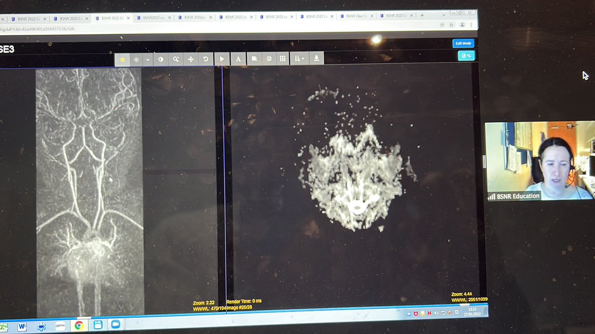 Ian Craven (@radiologyian) on Twitter photo Great paediatric stroke cases from <a href="/HelenCliffe2/">Helen Cliffe</a> from <a href="/LeedsRadiology/">LTHT Radiology</a> <a href="/AcademyRad/">Leeds Radiology Academy</a> for <a href="/theBSNR/">BSNR</a> paeds stroke module. Free for everyone to attend every Monday lunchtime <a href="/BSPRJuniorForum/">BSPR</a> <a href="/the_bpng/">BPNG</a> <a href="/_the_SRT/">The Society of Radiologists in Training</a> Great paediatric stroke cases from <a href="/HelenCliffe2/">Helen Cliffe</a> from <a href="/LeedsRadiology/">LTHT Radiology</a> <a href="/AcademyRad/">Leeds Radiology Academy</a> for <a href="/theBSNR/">BSNR</a> paeds stroke module. Free for everyone to attend every Monday lunchtime <a href="/BSPRJuniorForum/">BSPR</a> <a href="/the_bpng/">BPNG</a> <a href="/_the_SRT/">The Society of Radiologists in Training</a>