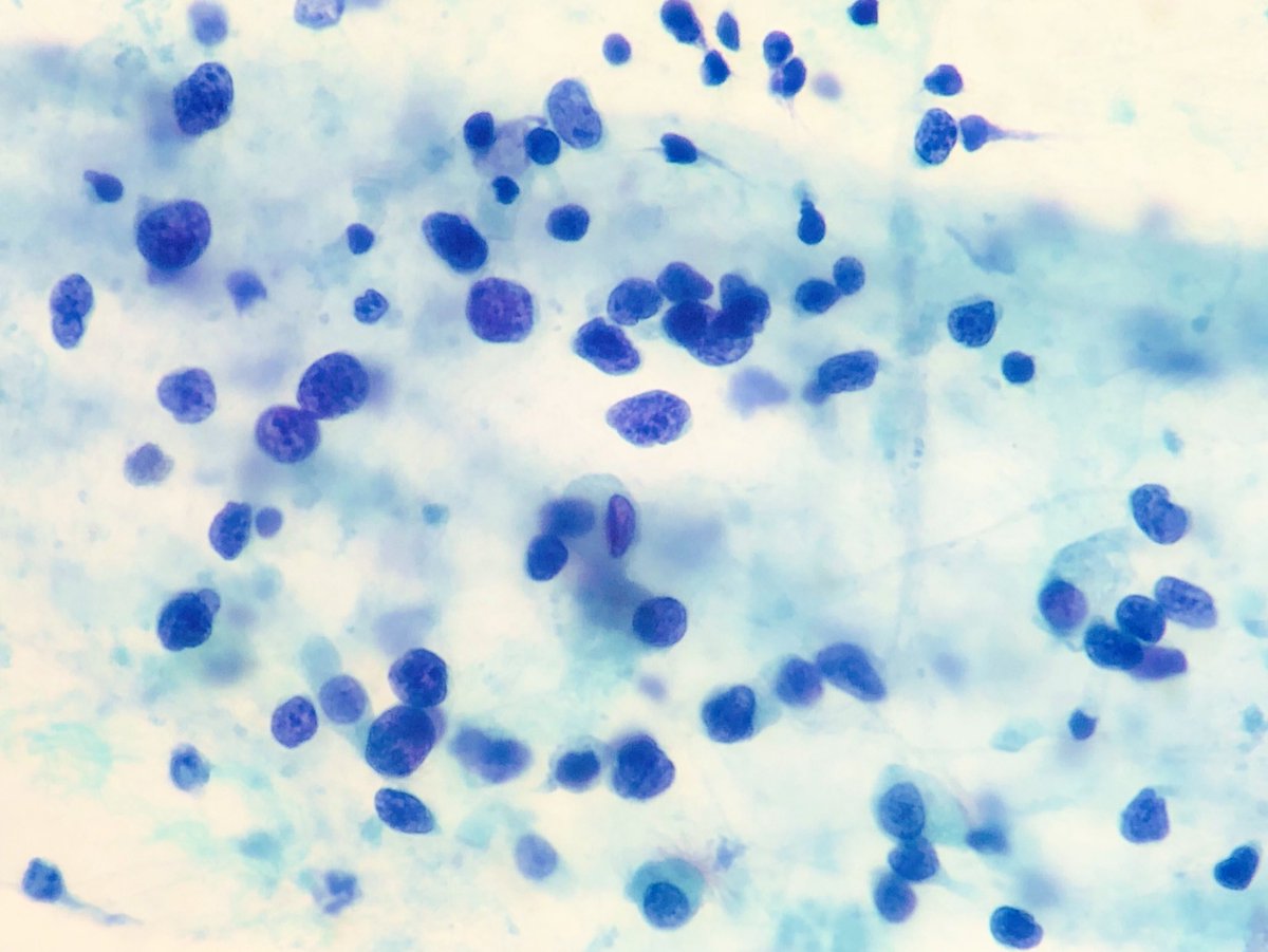 Cell_ebrities's tweet photo. Small Cell Lung Carcinoma 
#Cytology : bronchial aspirate, compare with ciliated cells and #Histology: bronchial biopsy
#Cytohistocorrelation #pulmpath #Cytopath #SCLC #LCSM #Bellvitgepath https://t.co/IaJw5pNpJt