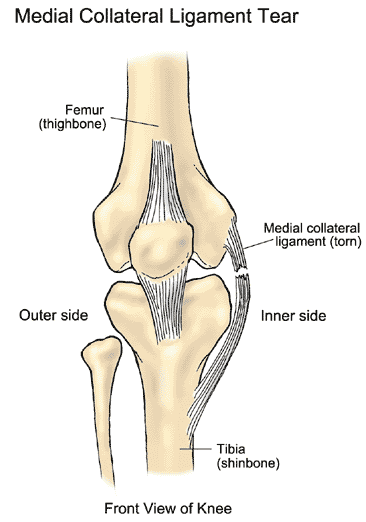 KinectMD's tweet image. #KevinDurant was diagnosed with a sprained Medial Collateral Ligament (MCL) in his left knee after his teammate fell backward into his knee. The MCL is injured in at least 42% of ligamentous knee injuries, with isolated MCL injuries accounting for 29%. #KinectMD #SportsMedicine