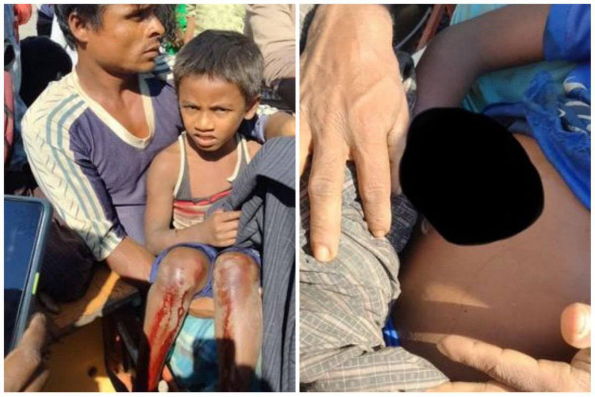 Tw//blood 2 Muslim 8yos Children who picked old artillery shells from the farm to play were seriously injured and in serious condition in MyaukU, Rakhine state.The shells to be left by Junta from Battalion 541. #2022Jan17Coup  #WhatsHappeningInMyanmar
