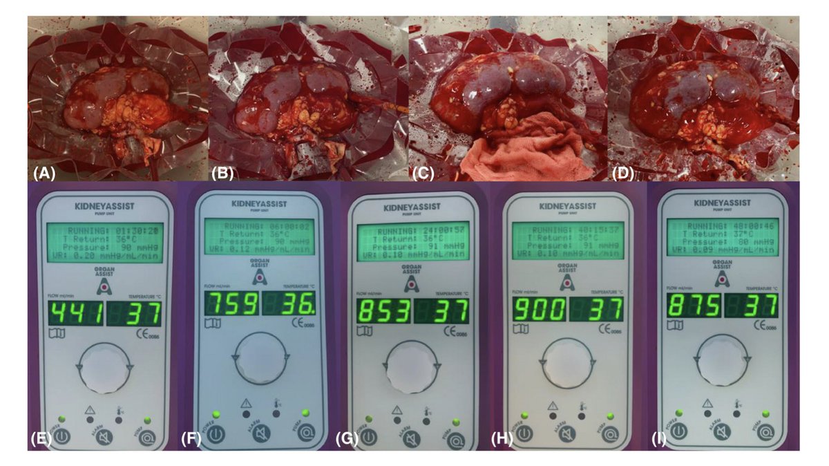 Artificial Organs (@artiforgans) on Twitter photo Forty-eight hours of #Normothermic #KidneyPreservation applying #Urine #Recirculation👇
bit.ly/3FCz7tC | #FreeAccess
@imed_tweets🇦🇹| @AnnaAustrie <a href="/FrankaMessner/">Franka Messner</a> @schneest #ESRD #KidneyGraft #Perfusion Forty-eight hours of #Normothermic #KidneyPreservation applying #Urine #Recirculation👇
bit.ly/3FCz7tC | #FreeAccess
@imed_tweets🇦🇹| @AnnaAustrie <a href="/FrankaMessner/">Franka Messner</a> @schneest #ESRD #KidneyGraft #Perfusion