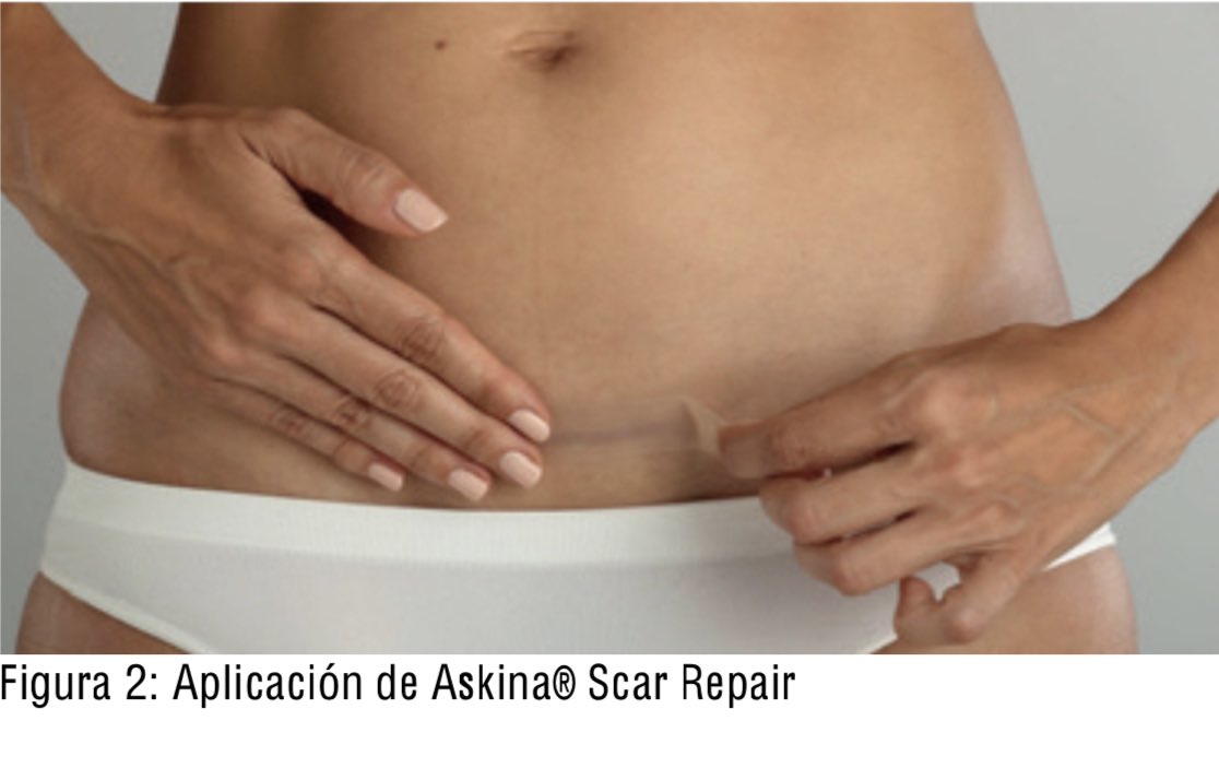 UlcerasChile's tweet photo. Estudio clínico sobre la utilización conjunta de Linovera® Scar Repair y Askina® Scar Repair en mujeres con cicatrices post-cesárea.
Caso destacado en ÚLCERAS CHILE #bbraunchile https://t.co/qU4gUvtWrW