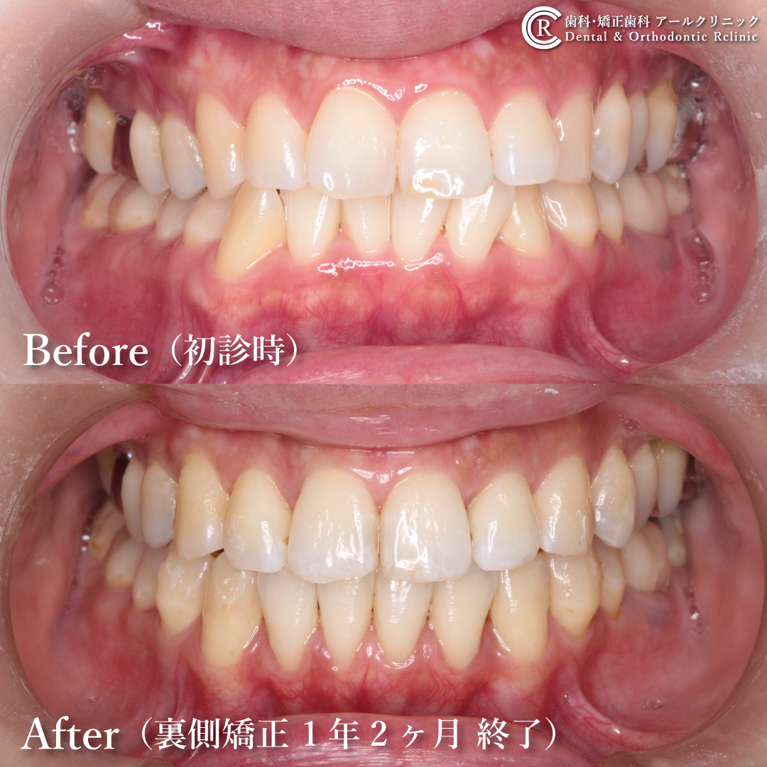 歯科 矯正歯科アールクリニック こんにちは 山口県宇部市の歯科 矯正歯科アールクリニックです 40代女性 前歯のガタガタと出っ歯を治したい というお悩みを矯正治療で解決しました 矯正女子 矯正男子 歯列矯正 ビフォーアフター T Co