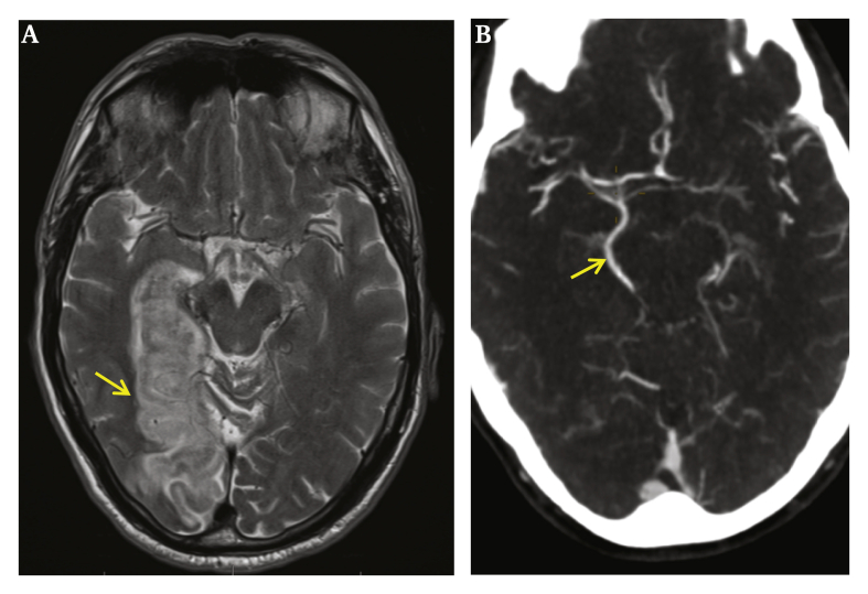 WorldStrokeEd's tweet image. #MondayTip

☝️Don't forget  to look for the #origin of #posterior cerebral artery #PCA, when evaluating a posterior circulation #stroke 

#Fetal

🔹bit.ly/3fFftmd
🔹bit.ly/3qB2JmW