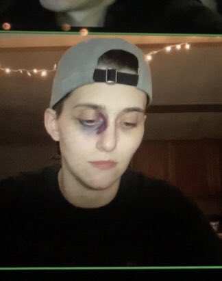 KerriSmith2012's tweet photo. #ImpossibleLandscape spoilers.
My black eye for the #DeltaGreen session last night because I got a needle in the eye in the hospital in the session before 😅 I wish I took a pic before my glasses smeared it a little bit, but that’s okay. #ttrpg https://t.co/L24gbQcb7I