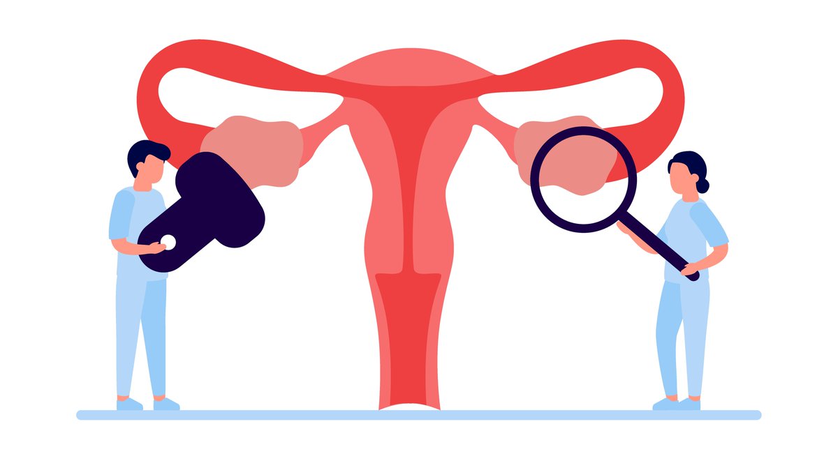 JMG (@jmg_bmj) on Twitter photo Case: #BRCA1 +ve ♀️ develops peritoneal #Cancer (HGSC)
- Despite risk-reducing surgery 15y ago
- Arose from tiny, dormant fallopian tube serous tubal intraepithelial carcinoma (STIC)
Read here: bit.ly/3fAURfa
<a href="/SetFelix/">Setor Amuzu</a> <a href="/DemkoNadia/">Nadia Demko, MD, CM, MSc</a> <a href="/BRivera_Polo/">Barbara Rivera</a> <a href="/PolakPaz/">Paz Polak</a> #OvarianCancer Case: #BRCA1 +ve ♀️ develops peritoneal #Cancer (HGSC)
- Despite risk-reducing surgery 15y ago
- Arose from tiny, dormant fallopian tube serous tubal intraepithelial carcinoma (STIC)
Read here: bit.ly/3fAURfa
<a href="/SetFelix/">Setor Amuzu</a> <a href="/DemkoNadia/">Nadia Demko, MD, CM, MSc</a> <a href="/BRivera_Polo/">Barbara Rivera</a> <a href="/PolakPaz/">Paz Polak</a> #OvarianCancer