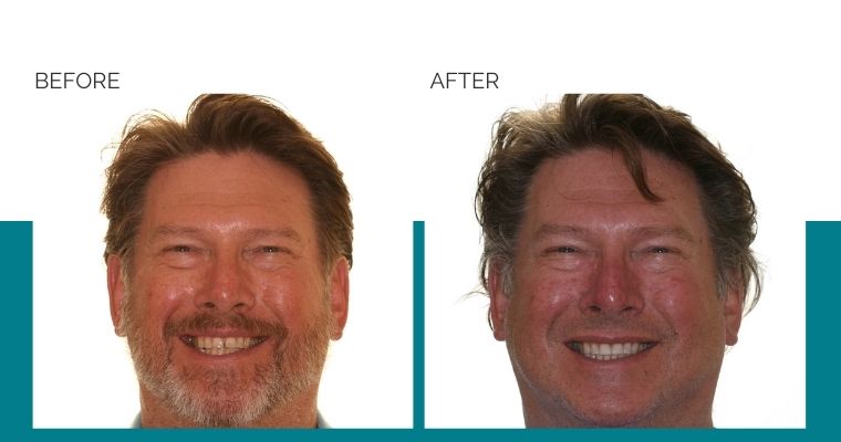 SchurOrtho's tweet photo. New post (Invisalign® Before and After: A Real Patient's Transformation [VIDEO]) has been published on Schur Orthodontics - https://t.co/hikH9xp0bH https://t.co/b74uBMUcZG