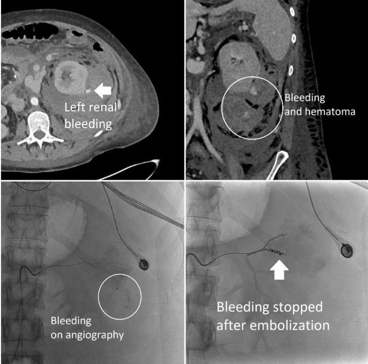 Renal biopsy for acute kidney injury complicated by bleeding resulting in hemorrhagic shock. The upside of significant bleeds like this one is that once you locate and occlude the offending vessel, the patient often has a rapid improvement in clinical status. #IRad