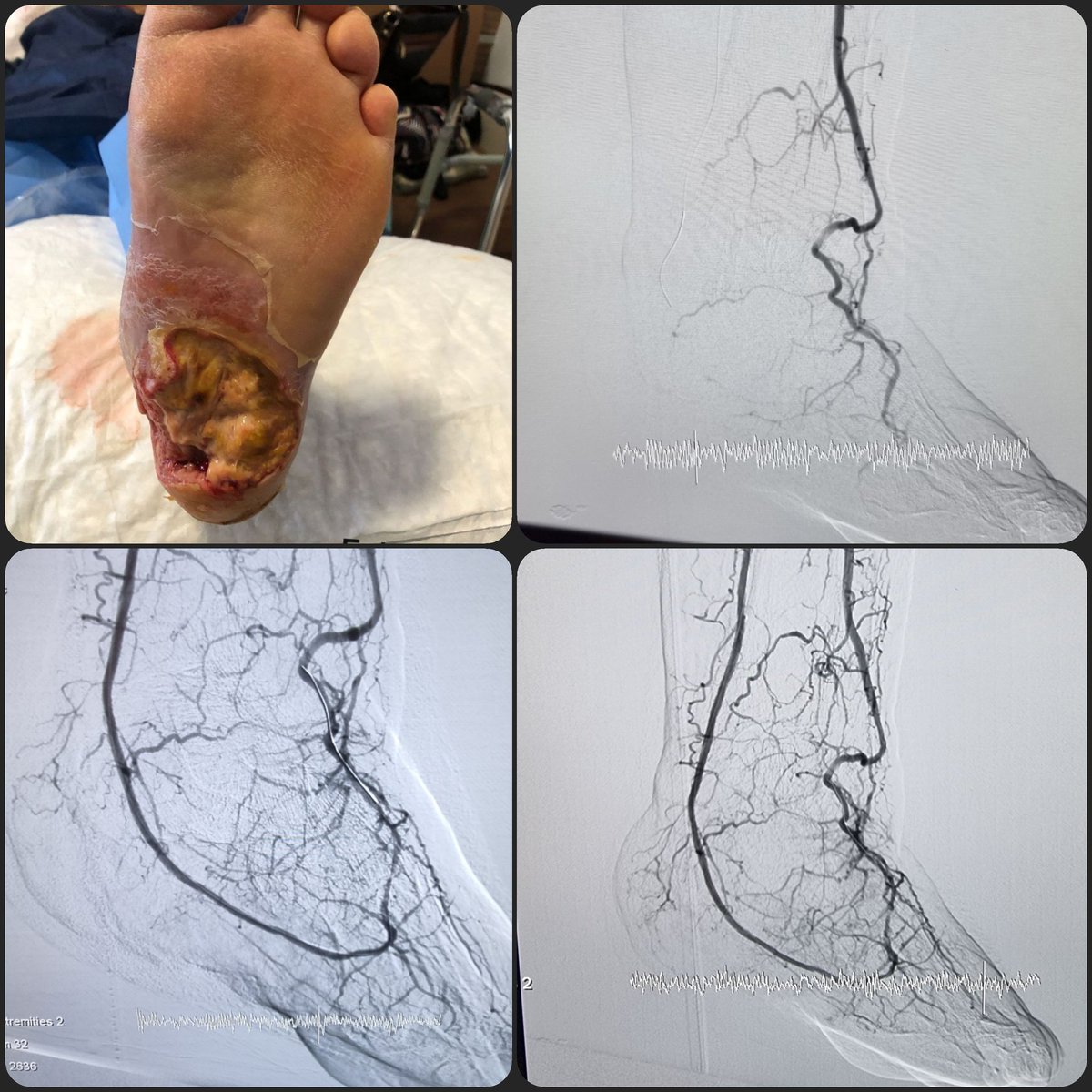 Revascularization is important in diabetic foot ulcer.wounds on the heels cause more major amputations than other regions.therefore it deserves more aggressive revascularization. #dfu #peripheral #amputations