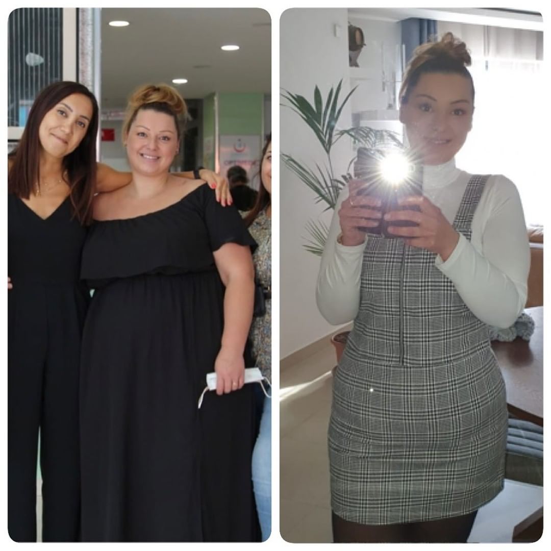TrendHealthtr's tweet photo. Marceline😍
She has lost 40 kilos already and she is still loosing weight
🌸🌺
#bariatricsurgery #gastricbypass #obesity #obestysurgery #trendhealth #healthtourismturkey #sleevegastrectomy https://t.co/EK7tYKDZ00