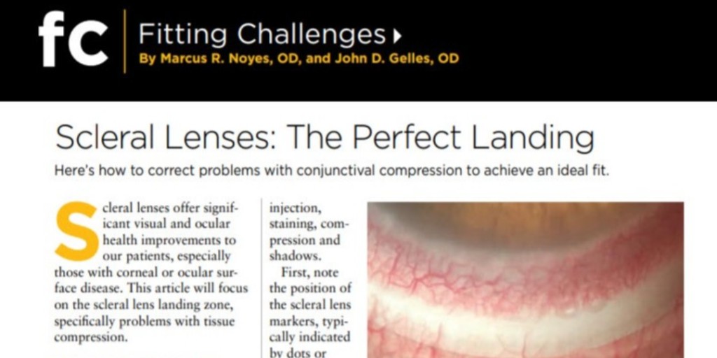 Scleral Lenses: The Perfect Landing
Here’s How To Correct Problems With Conjunctival Compression To Achieve An Ideal Fit.
By Marcus R. Noyes, OD, and John D. Gelles, OD
Review of Cornea &amp; Contact Lens September/October 2021

Follow link: ow.ly/F2iA50Hwixo

<a href="/KeratoconusUS/">keratoconusus</a>