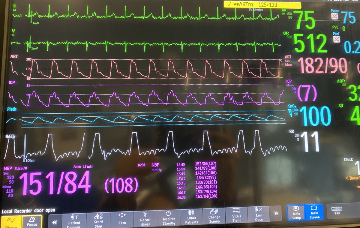 aartisarwal's tweet photo. #NeuroICU #MedEd enthusiasts 

❓What’s peculiar about #ICP waveform in this monitor tracing? ❓

How does this finding change your 🧠management? 

@neurocritical @SNACCNeuro @SCCM @AANMember https://t.co/VUCc7YqyOg
