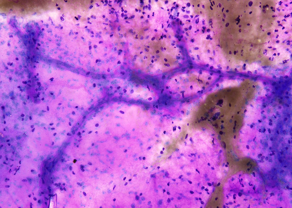 sza_jhcyto's tweet photo. This soft tissue tumor is the one that I almost every time feel totally confident to sign-out even without a cell block - "Myxoid Liposarcoma" (classic "chicken wiring" by the proliferating capillaries). https://t.co/70FuAWgAcQ