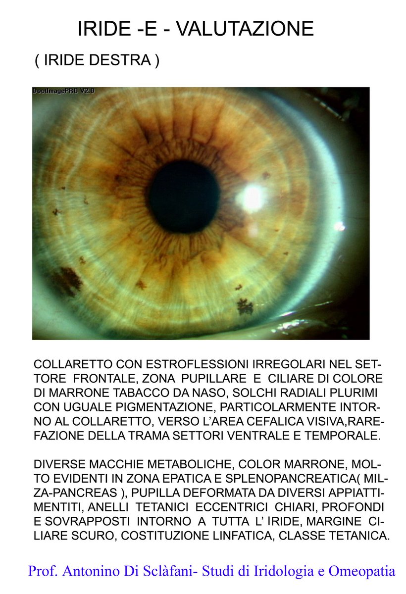 Una iride esaminata, da cui si rilevano disfunzioni e alterazioni per la maggior parte irreversibili./<a href="/iridiesalute/">antonino.di.sclafani/@iridiesalute</a>/#AntononinoD./#Ricerca.