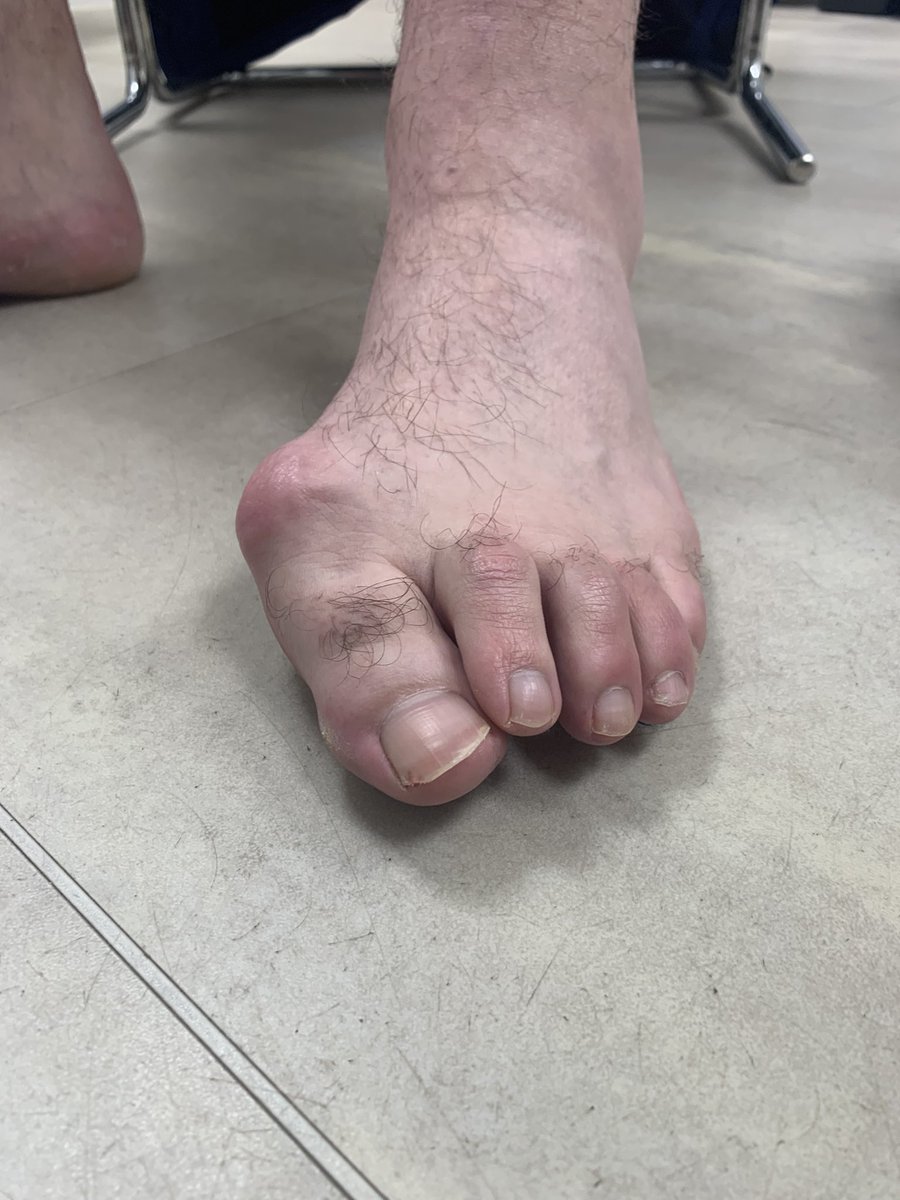 This gentleman has waited for years, finally deciding to get this fixed . He is in a lot of pain from all the #toes. #Surgery for #forefoot #deformities are indicated only for #pain relief and I am glad he waited till he could not cope. I have now offered him #surgery.