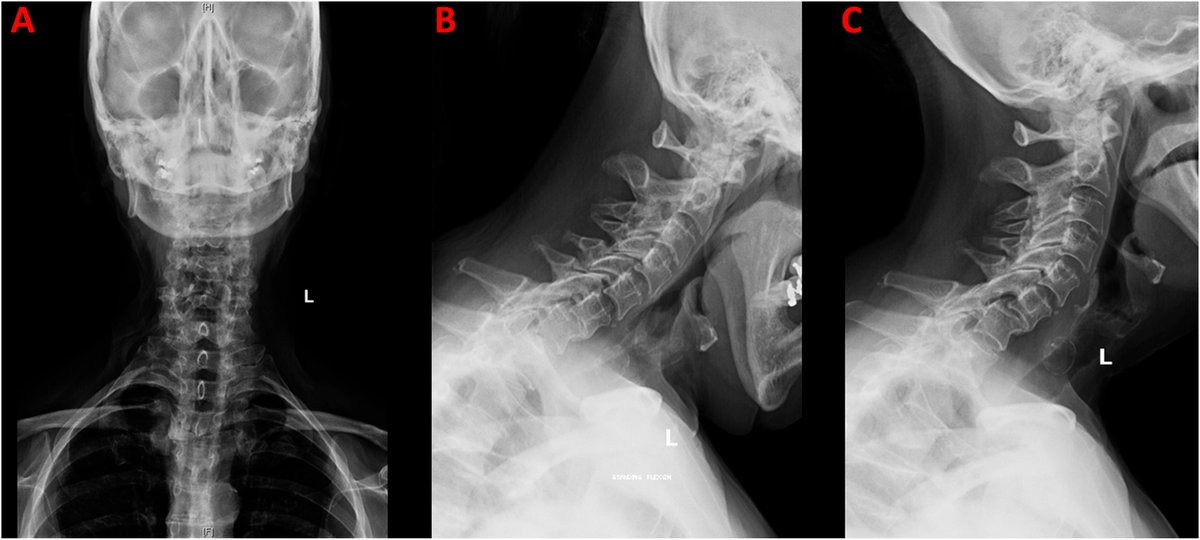 jbjs's tweet photo. Nonoperative Management of Chronically Subluxated Bilateral Cervical Facets with Bony Fusion #orthotwitter #cervical #nonoperative
https://t.co/O2SCWGfkhM https://t.co/U8mzqbC3kc