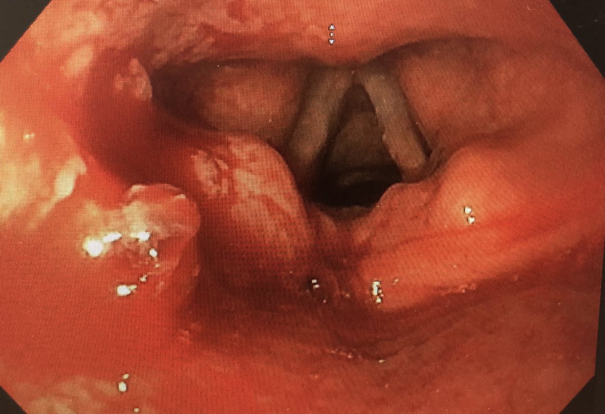 Solicitan gastroscopia urgente por hematemesis. La importancia de una buena exploración orofaringea. #DigestivoGandia <a href="/Tokioblues2/">Tokioblues</a> <a href="/marilozahonero/">Mariló</a> <a href="/ClarsPeiro/">Clara Navarro</a> <a href="/escapa79/">Vanesa M. Escapa</a> <a href="/TOMASFUSTERBELL/">TOMAS FUSTER BELLIDO</a> <a href="/alemany_gloria/">Gloria Alemany Perez</a> <a href="/Medicilio/">Dra. Elena Casado Pineda</a>