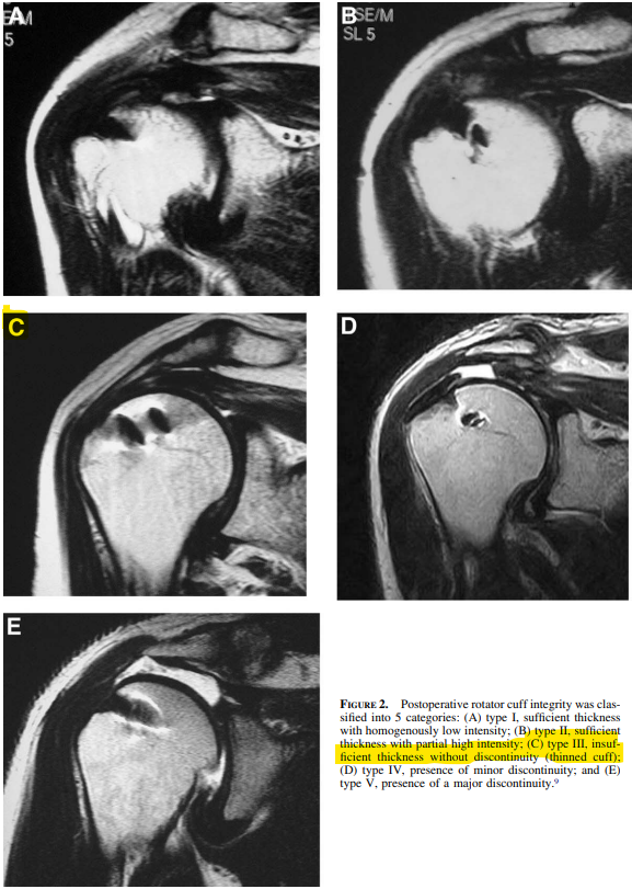 At 10 years, Sugaya type 3 re-tear had better functional outcome and less muscle degeneration compared to Sugaya type 4/5 re-tear. When evaluating rotator cuff integrity on MRI, do you consider Sugaya type 3 re-tear analogous to “failure-in-continuity”? jshoulderelbow.org/article/S1058-…