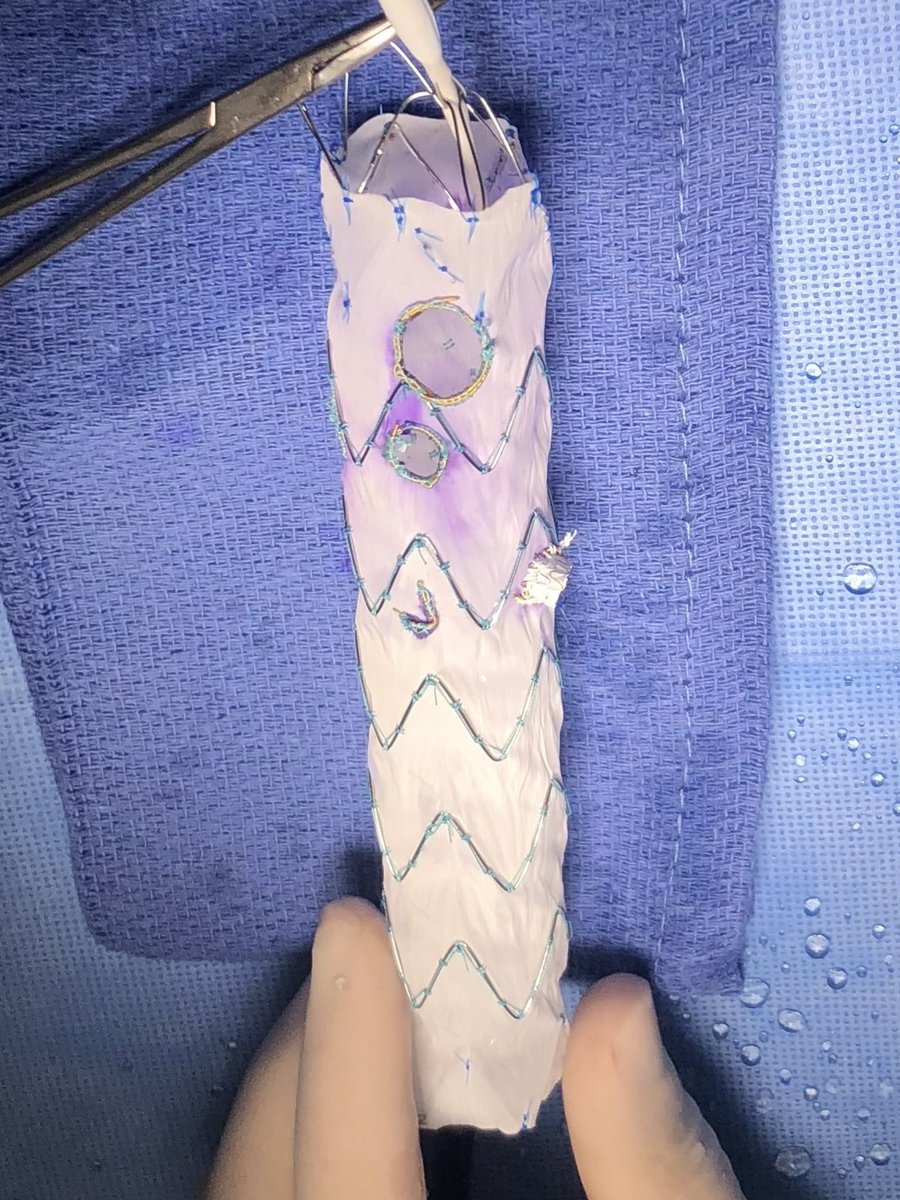 DanielMilesMD's tweet photo. 11cm symptomatic extent IV #TAAA? Urgent (planned morning of) &amp; First-ever 4 vessel PMEG at @CedarsSinai with an excellent result and recovering well! @MoridzadehMD @VSA_LLC @VascularSurgCS @DeptSurgeryCS #VascSurg #VascularTwitter #Aorta #AortaEd #MedEd https://t.co/fixhNcdi9n