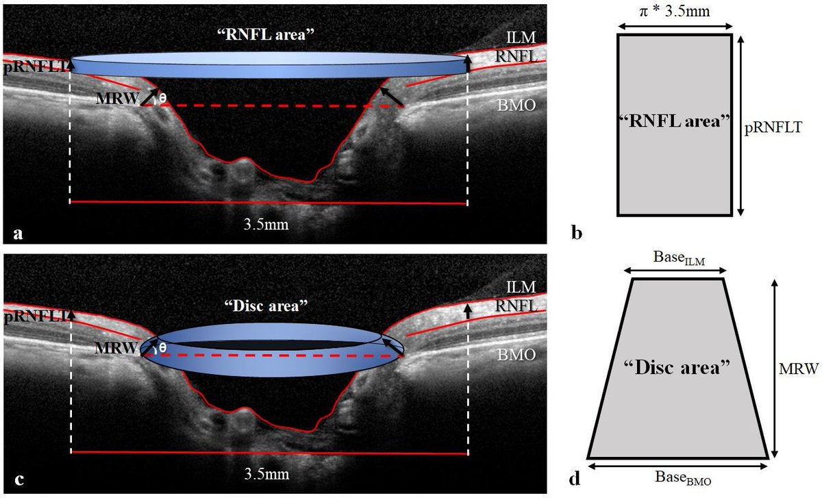diepbiomed's tweet image. Graefes rdcu.be/cDDhH Optic Nerve Head Parameter   #Glaucoma from Non-Glaucomatous #RNFL #BRVO @ClinMedJournals @Ophthalmologen @meyer_professor @oliverzeitz @AndrzejGrzybow @EdmundTsuiMD @SakamotoTaiji @KopicAndrijana @JiaHorungMD @KusuharaSentaro @SpringerSurgery