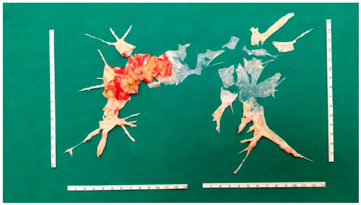 diagnostic_mdpi's tweet image. #mdpidiagnostics Chronic #Thromboembolic #Pulmonary Hypertension: An Update. View Full Link: mdpi.com/2075-4418/12/2….