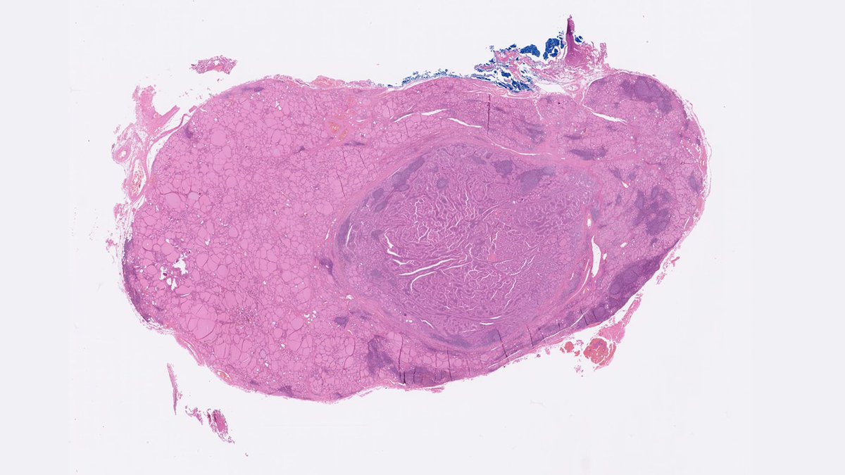 DrJuhlin's tweet photo. Warthin-like papillary thyroid carcinoma. 

🔬Papillae lined with oncocytic cells, with prominent lymphocytic infiltration of stalks. Tumor nuclei are enlarged, irregularly sized with grooves and occasional pseudo-inclusions. Background of lymphocytic thyroiditis. https://t.co/R5Jneuagg1