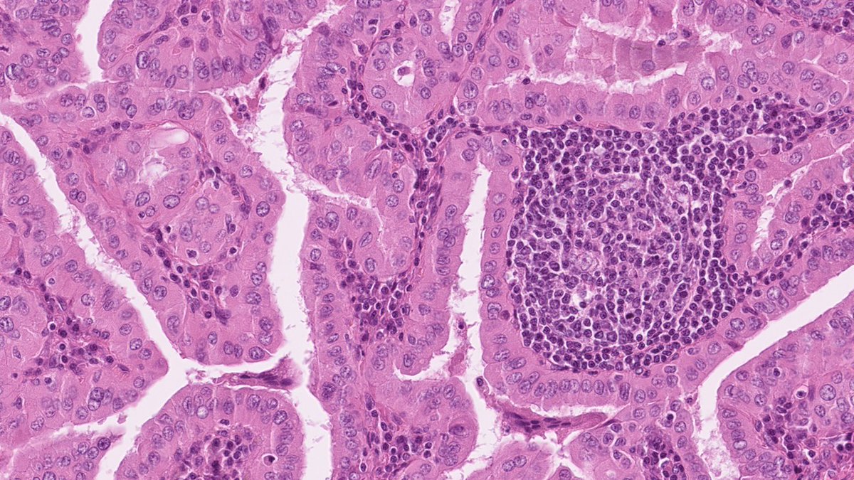 DrJuhlin's tweet photo. Warthin-like papillary thyroid carcinoma. 

🔬Papillae lined with oncocytic cells, with prominent lymphocytic infiltration of stalks. Tumor nuclei are enlarged, irregularly sized with grooves and occasional pseudo-inclusions. Background of lymphocytic thyroiditis. https://t.co/R5Jneuagg1