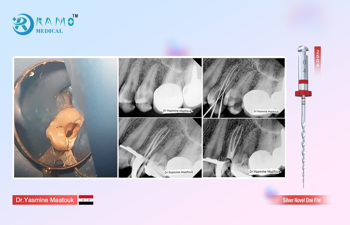 RamoMedical's tweet photo. β€οΈCase Sharing of Dr.Yasmine Maatouk from Syria.β¨
πRCT for upper 1st premolar with three canals .
πRotary file :
πRCS Silver Novel One File 25/04
#RamoMedical #NovelOne #OneFile #RotaryFile #Endodontic #Dentistry #Dentist https://t.co/e2102CzYi5