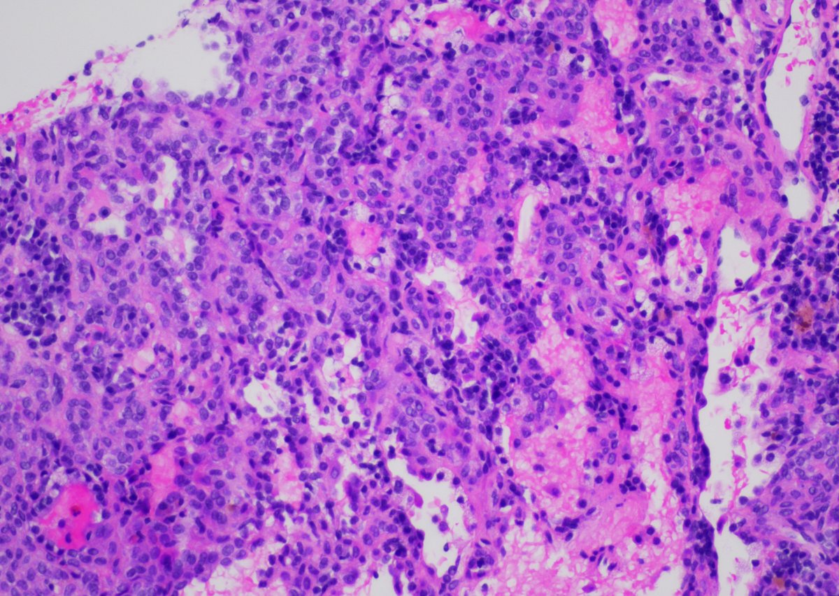 65yo F with 1.3cm LLL lung nodule. Core biopsy of the mass was performed. #pathology #pathtwitter #pulmpath #pathboards <a href="/ChoudhuriJui/">Jui Choudhuri</a> <a href="/ridin_bk_MD/">Ridin Balakrishnan, MD</a> <a href="/pembeoltulu/">Pembe Oltulu, MD</a> <a href="/ariella8/">Celina Stayerman MD</a>  <a href="/DrVish/">Vish Killari MD MPH</a> <a href="/Dr_Brian_Cox/">Brian Cox, MD, MAS</a> <a href="/DrRanasaleh/">Rana Saleh, MD</a> <a href="/ALBoothMD/">Adam L. Booth, MD</a>
