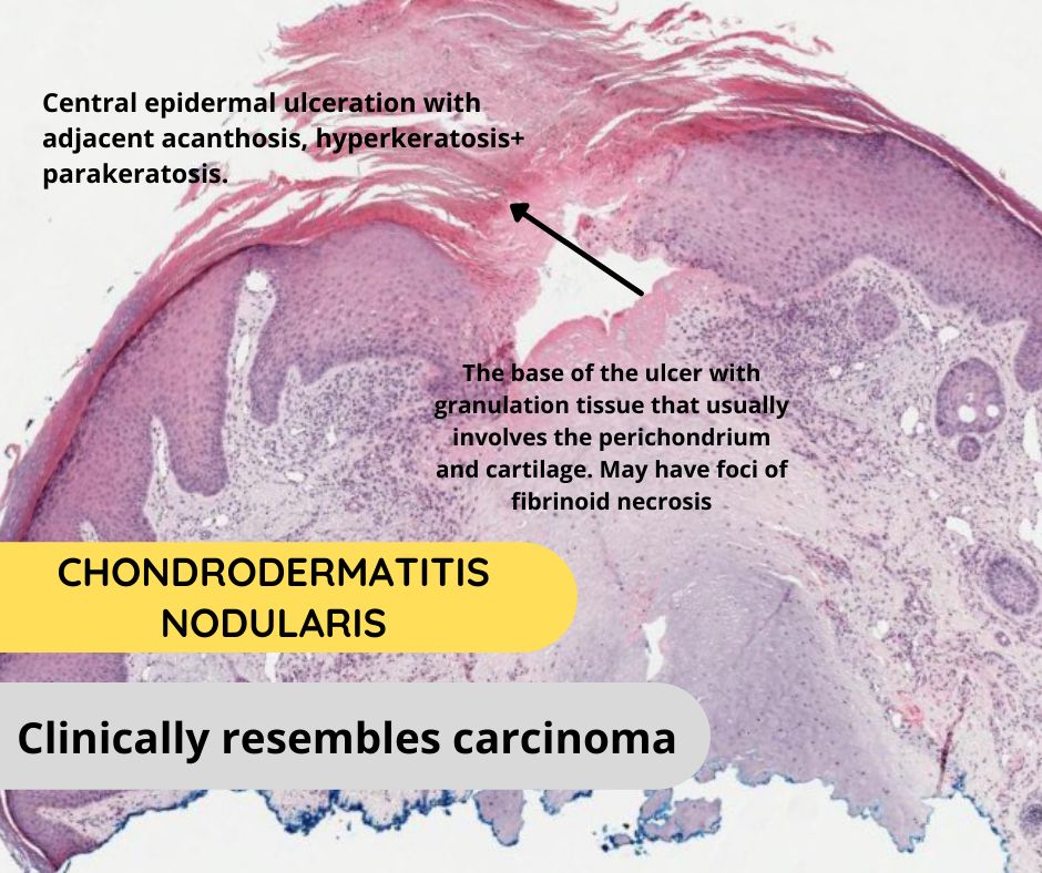 GeronimoJrLapac's tweet photo. #dermpath #pathology
Credit: #pathpresenter https://t.co/rqU2gHo567