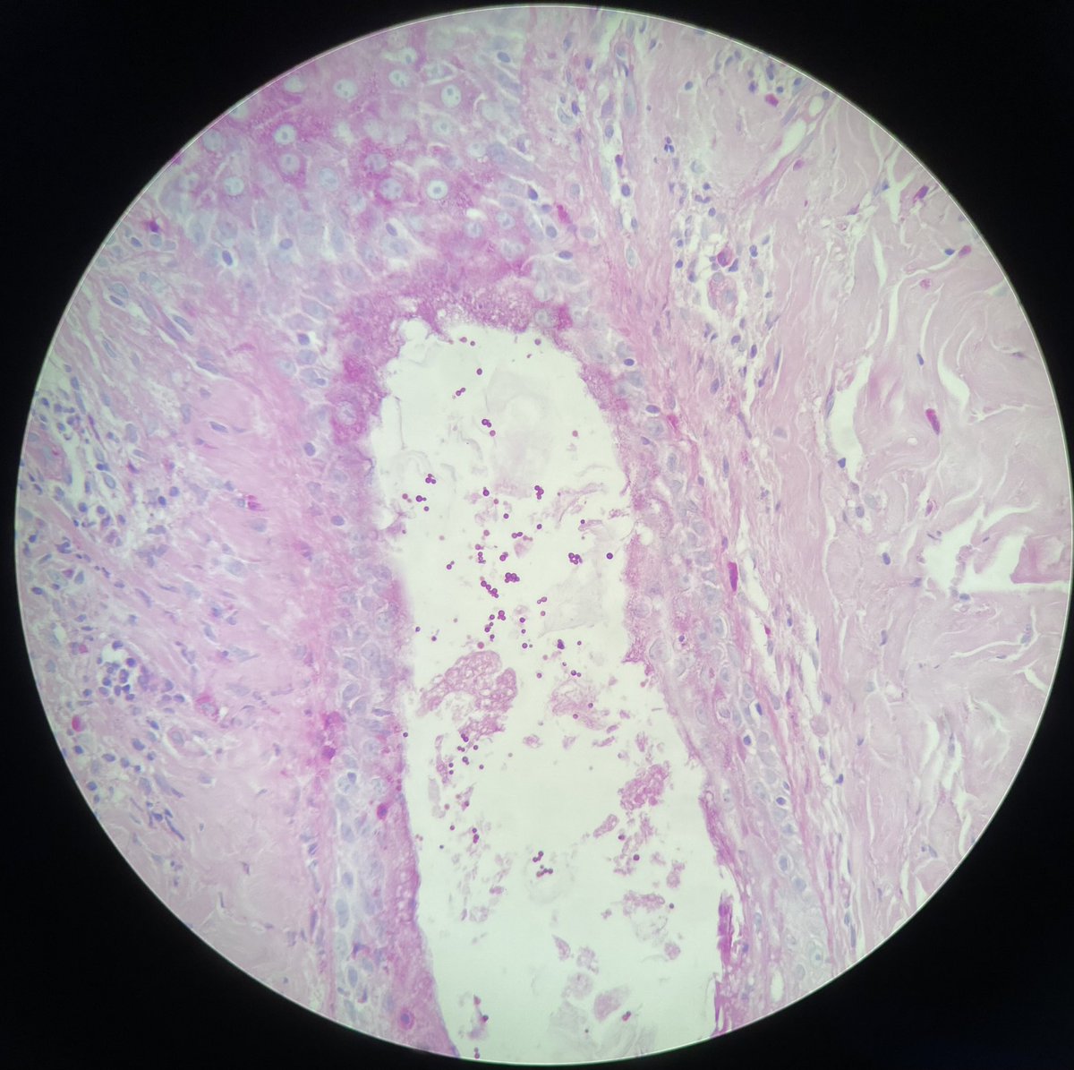 rejeeve's tweet photo. Malassezia folliculitis presenting as a rash over the trunk&amp;thighs. PAS stain highlights the fungal elements, also seen on H&amp;E. Suppurative folliculitis involving the isthmus and infundibular portions. One “clown with clown nose” type yeast is seen. #dermpath https://t.co/nRjRjc1OoS