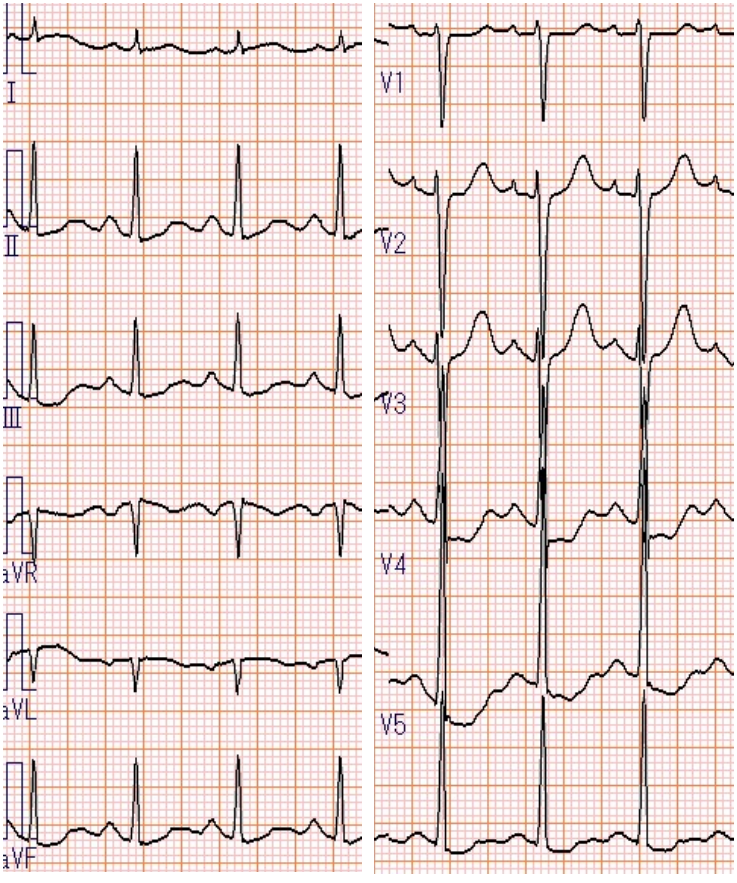MasriAhmadMD's tweet photo. A health 30 year old woman presented with sudden chest pain 2 days post 2nd #COVID19 mRNA vaccine shot. Here is the #EKG - follow along 
A new #CircImage in @CircImaging 
#CardioTwitter https://t.co/QxrhJ0rEdN