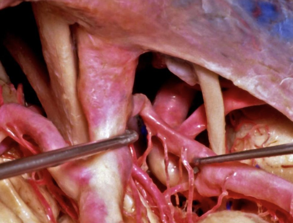 cvsection's tweet image. The Posterior Communicating Artery #PCom (shown here on the right from a superior view) connects the #anterior circulation from the #posterior circulation in the Circle of Willis  ow.ly/Z1gb50HfSEq