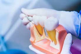 oralmed_j's tweet image. Check out the newly published article on The Role Of Vitamin D In Periodontal And Peri-Implant Health genesispub.org/j-oral-med-and…

You may also publish your work with us | E-mail us @ editorialoffice99@gmail.com

#dental #dentistry #submissionopen #retweet #researcharticle #dentmed