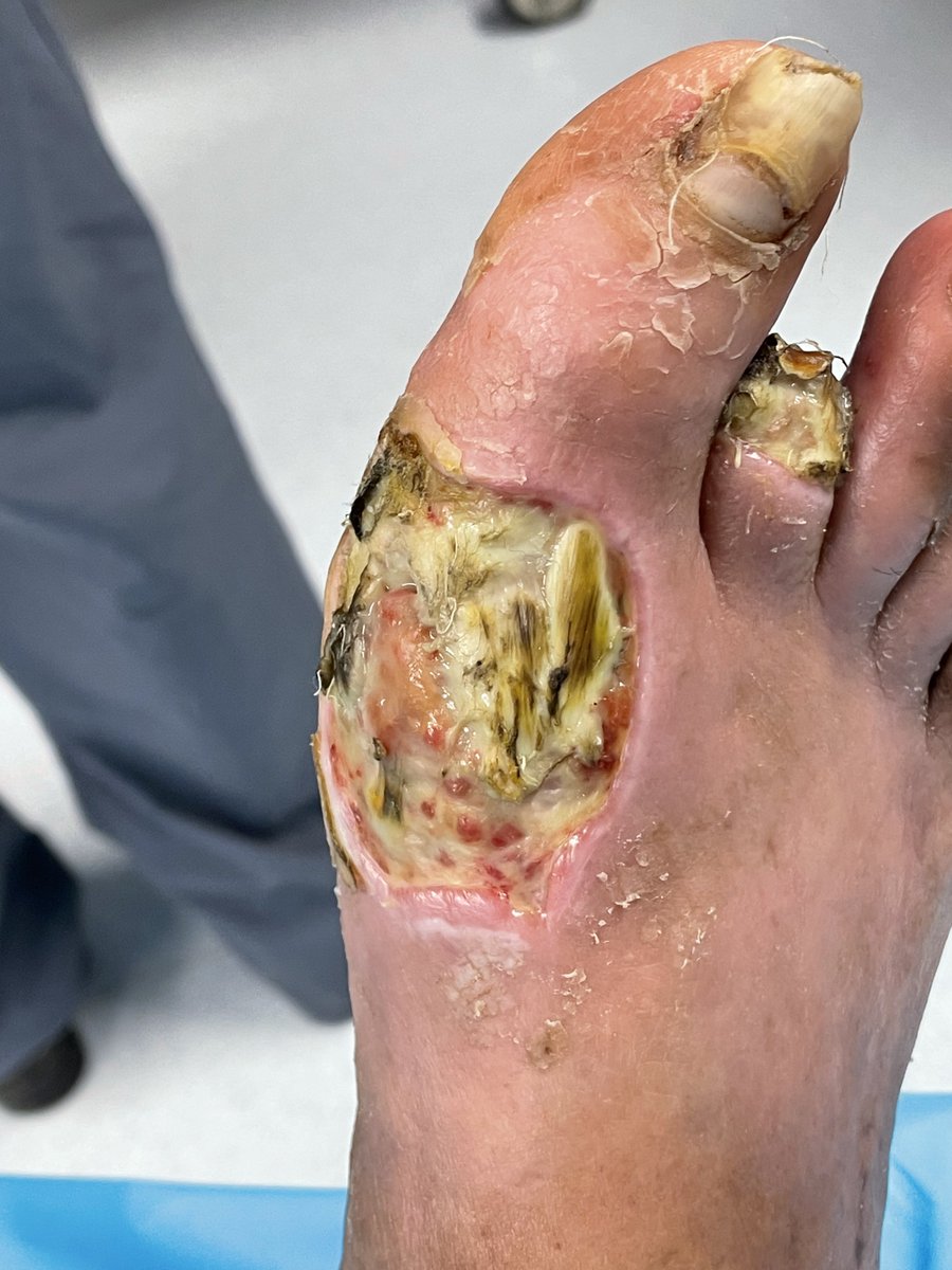 Dr_JMendivil's tweet image. The use of bone marrow aspirate concentrate (BMAC) intraoperatively to increase angiogenesis below the ankle. Adjunctive treatment to facilitate healing in limb threatening foot wounds in patients with type II diabetes and severe peripheral arterial disease. @terumobct #SaveALeg