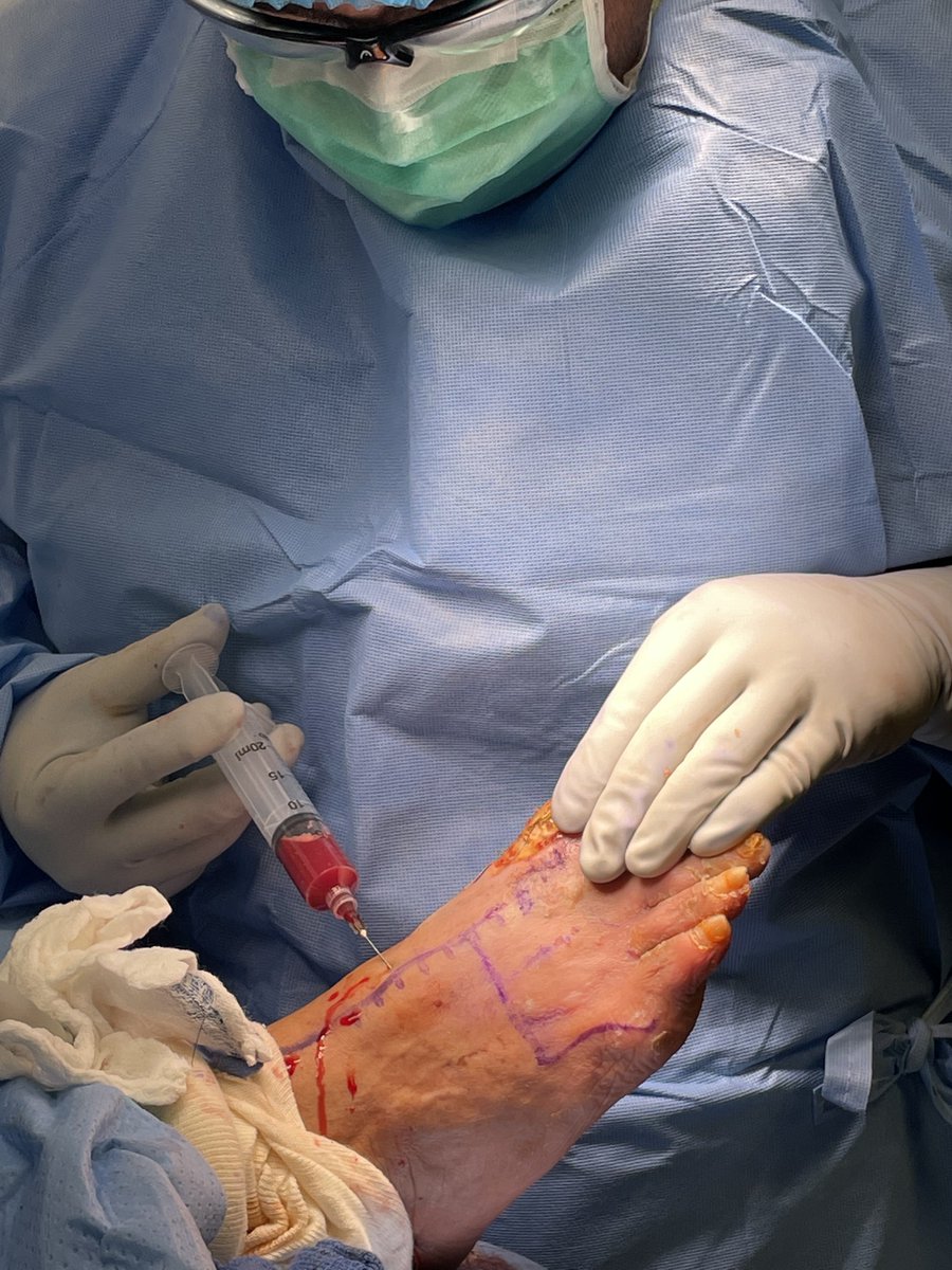 Dr_JMendivil's tweet image. The use of bone marrow aspirate concentrate (BMAC) intraoperatively to increase angiogenesis below the ankle. Adjunctive treatment to facilitate healing in limb threatening foot wounds in patients with type II diabetes and severe peripheral arterial disease. @terumobct #SaveALeg