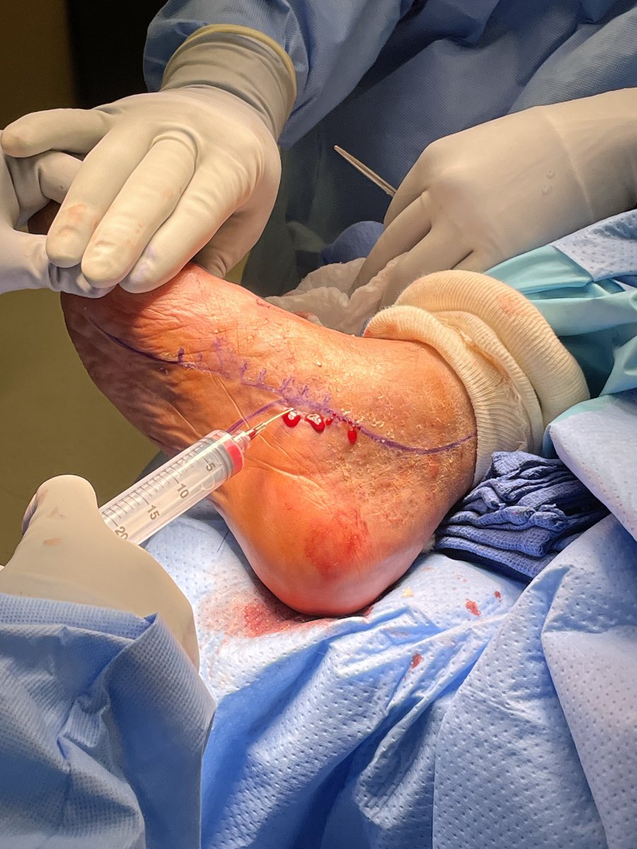 Dr_JMendivil's tweet image. The use of bone marrow aspirate concentrate (BMAC) intraoperatively to increase angiogenesis below the ankle. Adjunctive treatment to facilitate healing in limb threatening foot wounds in patients with type II diabetes and severe peripheral arterial disease. @terumobct #SaveALeg