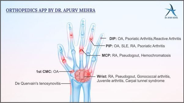 ApurvDr's tweet photo. #importantpoint
Hand is the common site for arthritis to happen. Some of the common types of arthritis that affects the hand are Osteoarthritis, Rheumatoid Arthritis, and Psoriatic Arthritis. It commonly attack 4 areas of hand i.e., CMC, MCP, DIP and PIP joints. https://t.co/iWGmIWjymM