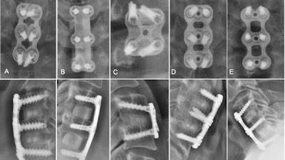 #DeepLearning accurately identifies cervical spine hardware brands doi.org/10.1148/ryai.2… @haritrivedimd @imonbanerjee6 <a href="/judywawira/">Judy Gichoya</a> #AI #ML #MachineLearning