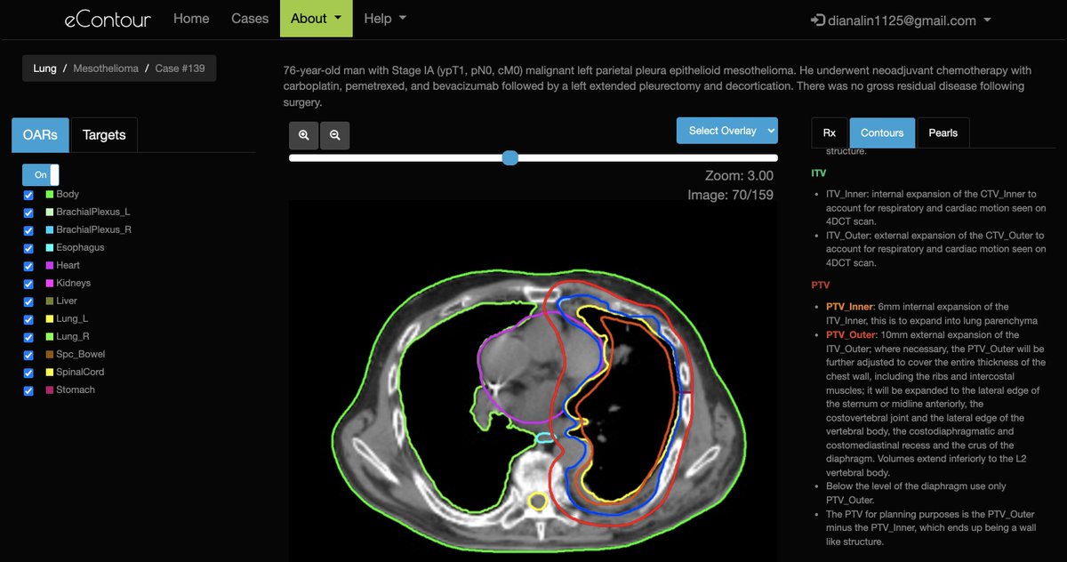 eContour (@econtourradonc) on Twitter photo 📢 Another awesome case from 🌟 resident <a href="/baileynelson92/">Bailey Nelson</a>, <a href="/NerdicasMaximus/">Emily Daugherty, MD</a>, and the <a href="/uofcincy/">University of Cincinnati</a> #radonc team now LIVE on #eContour ‼️
👀 this 🔥 NEW mesothelioma case: econtour.org/cases/139!
<a href="/ARRO_org/">ARRO</a> #MedEd 📢 Another awesome case from 🌟 resident <a href="/baileynelson92/">Bailey Nelson</a>, <a href="/NerdicasMaximus/">Emily Daugherty, MD</a>, and the <a href="/uofcincy/">University of Cincinnati</a> #radonc team now LIVE on #eContour ‼️
👀 this 🔥 NEW mesothelioma case: econtour.org/cases/139!
<a href="/ARRO_org/">ARRO</a> #MedEd