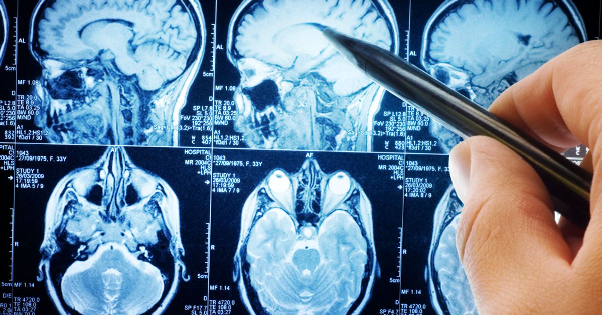 7 differences in #ADHD brain vs. the #neurotypical brain. "It's time that ADHD be recognized for what it is: a neurodevelopmental disorder, not a myth, nor a result of poor parenting." #ADD #specialeducation #educationaltherapy

zcu.io/Yt9I