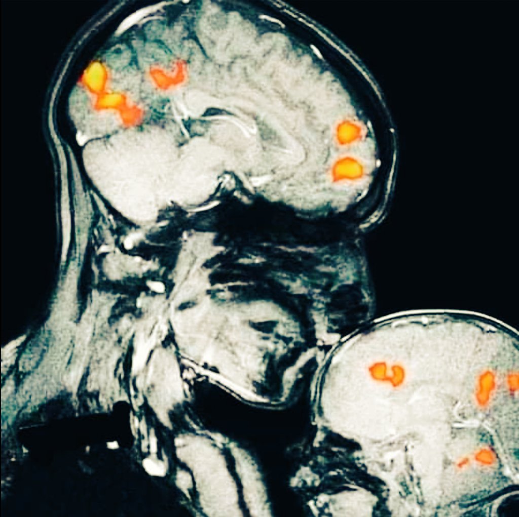 Aşağıdaki görüntüde bir annenin bebeğini alnından öperken çekilen MR görüntüsü var

Alnımızın tam ortası kişinin zihin odaklanma noktasıdır

Çocuğunuzu alnından öperseniz #EPİFİZ BEZİNİ ve buna bağlı olarakta #HİPOFİZ bezini aktifleştirirsiniz
Peki bunun ne gibi faydaları olur
👇