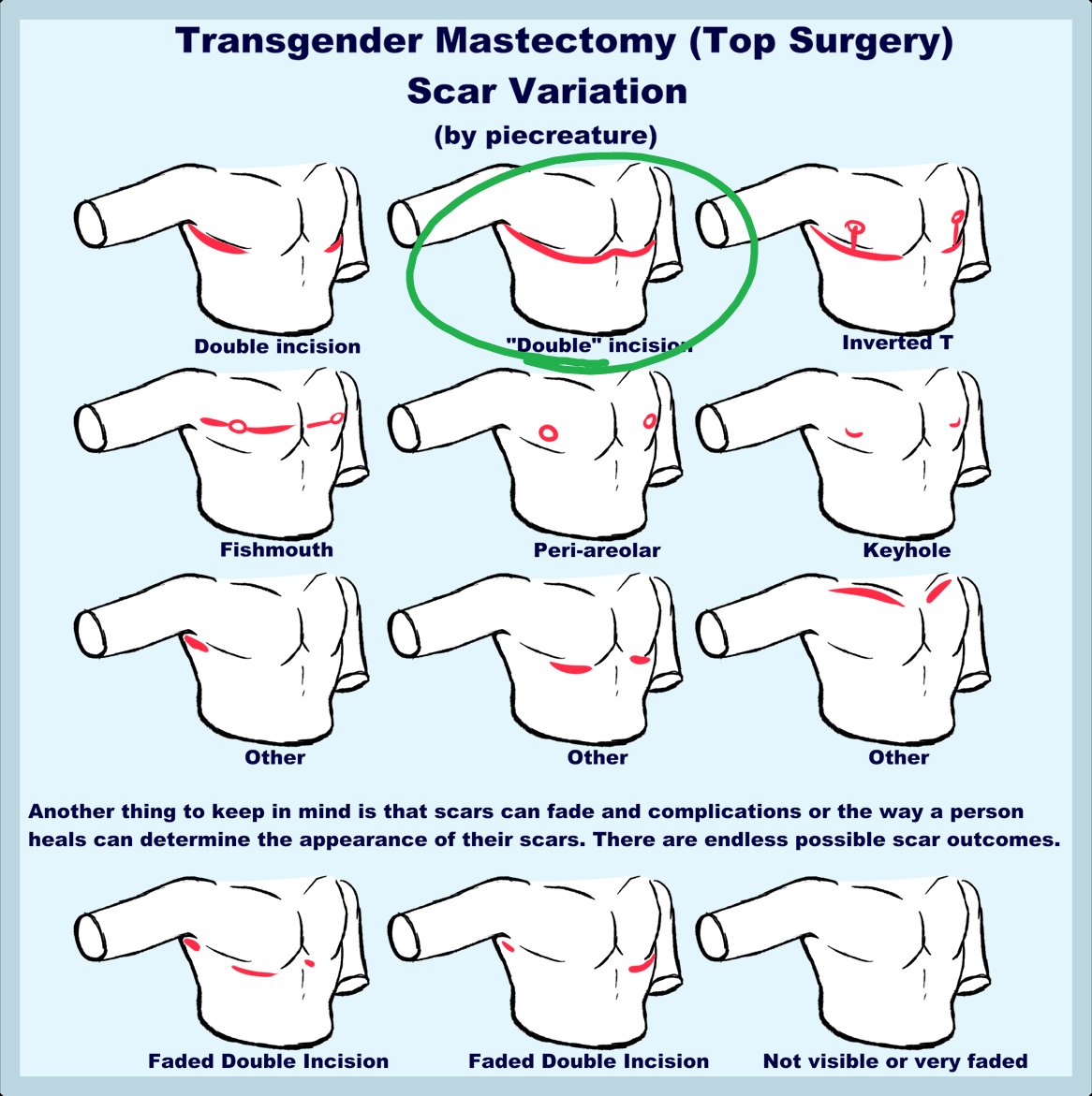 hed have the double incision kind 