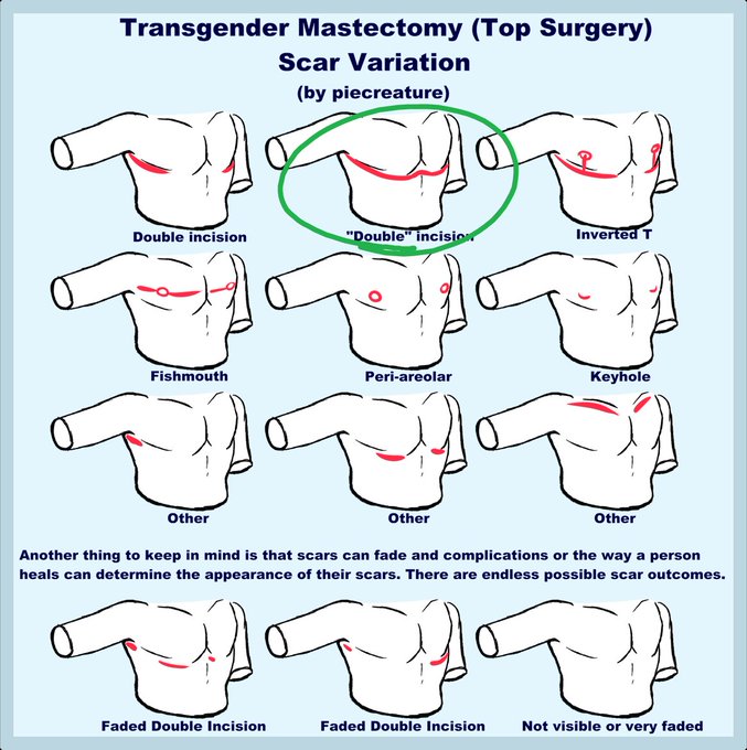 hed have the double incision kind 