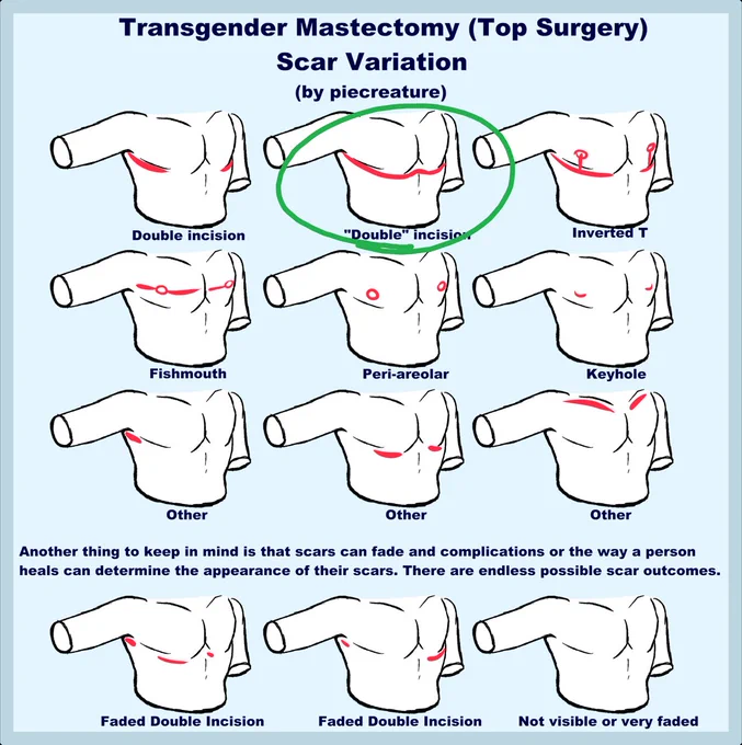 hed have the double incision kind 